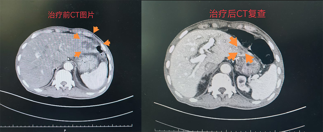 高龄糖尿病合并肝脓肿救治成功案例2.jpg